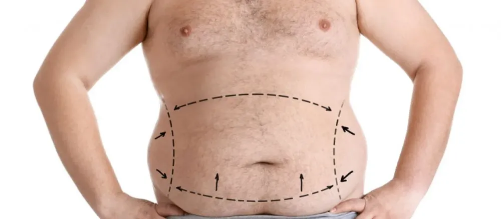 5 CUIDADOS PARA QUEM DESEJA FAZER UMA CIRURGIA BARIÁTRICA