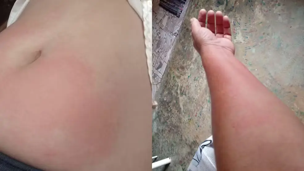 A MORADORA DE RONDÔNIA QUE NÃO PODE BEBER ÁGUA NEM SUAR POR CAUSA DE ALERGIA RARA