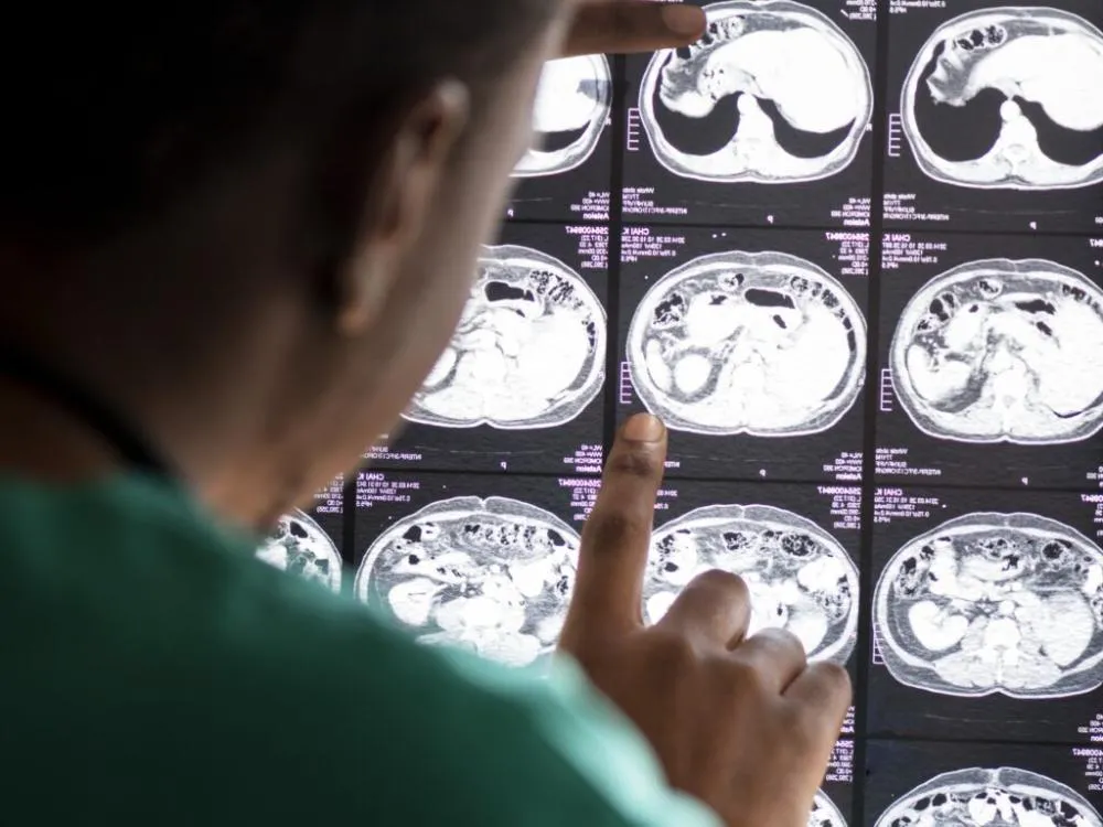 PESQUISADORES BRASILEIROS DESENVOLVEM MOLÉCULAS QUE MATAM CÂNCER CEREBRAL